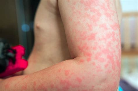 Alergia Pokarmowa Przyczyny Objawy Leczenie I Rodzaje Alergii Hot Sex Picture
