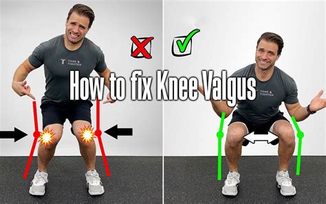 The Ultimate Guide To Fixing Knee Valgus Your Body Posture