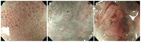 Endoscopic Findings Show The Superficial Esophageal Squamous Cell