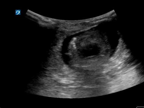 Incarcerated Umbilical Hernia Critical Care Sonography