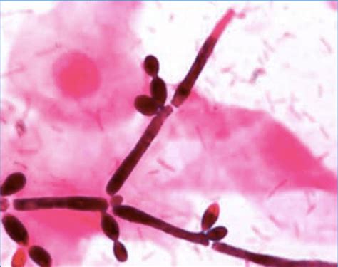 Candida Spp Bylc And Pseudohyphae Gram Stain Download Scientific