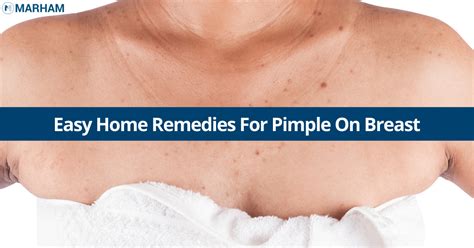 6 Amazing Home Remedies For Pimple On Breast Marham