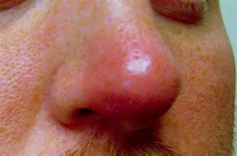 Swelling Bridge Of Nose