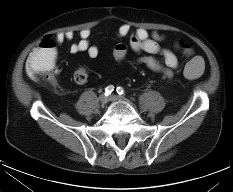 Stump Appendicitis Clinical And Ct Findings Ajr