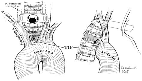 Tracheo Innominate Artery Fistula After Tracheostomy Anesthesia Analgesia