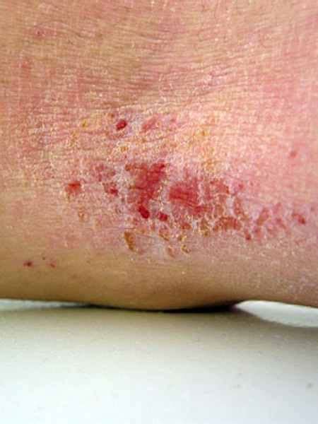 Can Eczema Lead To Psoriasis Dorothee Padraig South West Skin Health Care