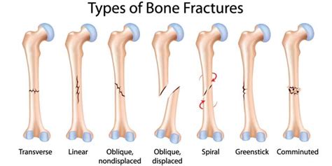 Fracture Bone Fracture Treatment