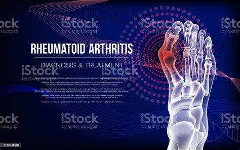 Rheumatoid Arthritis Bones The Of Foot Stock Illustration Download