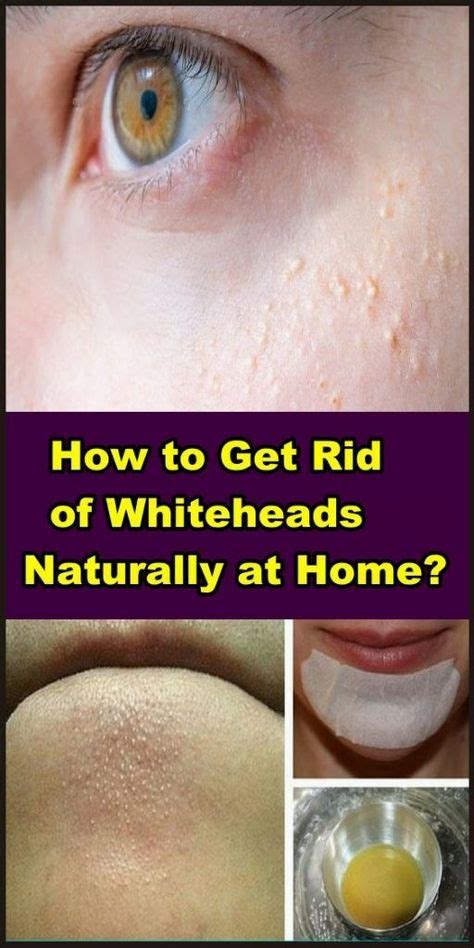 How To Get Rid Of Whiteheads Naturally At Home Face Errors