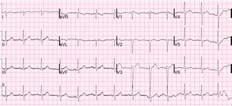One must always rule out the most serious differential. Myocarditis - ECG quest