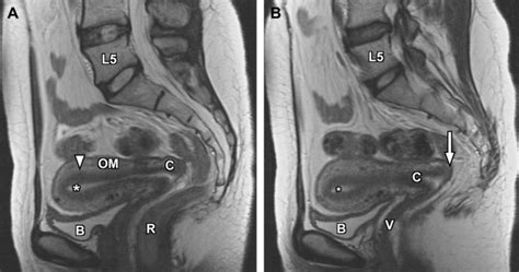 Normal And Variant Pelvic Anatomy On Mri Radiology Key