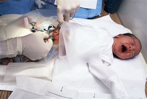 Circumcision Recovery Mariay La Galleta