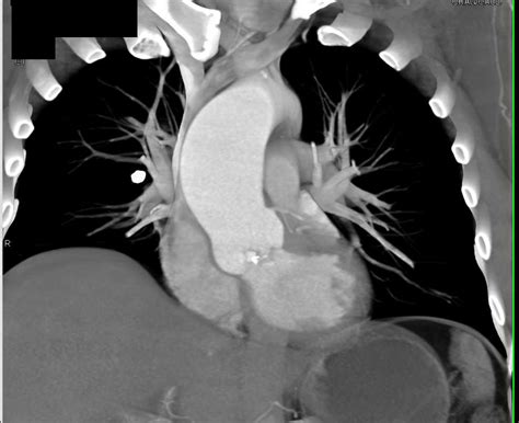 Aortic Valvular Calcification With Aortic Stenosis And Dilated
