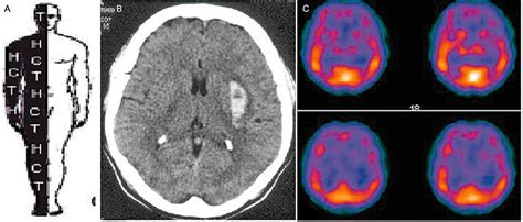 A The Right Hemibody Distribution Of Central Post Stroke Pain In A