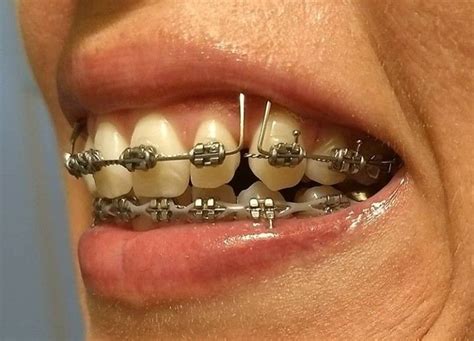 Braces Girlswithbraces Metalbraces Powerchain Loops Metal Braces Orthodontics Braces