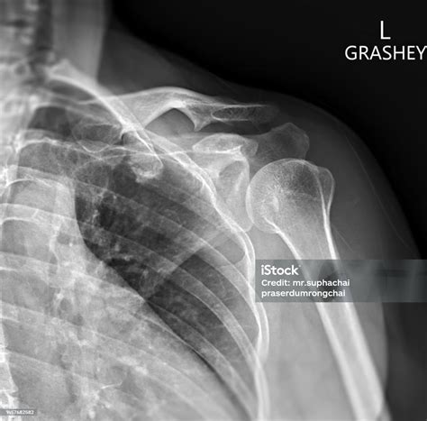 Xray Of Shoulder Joint Grashey View For Diagnosis Shoulder Joint From