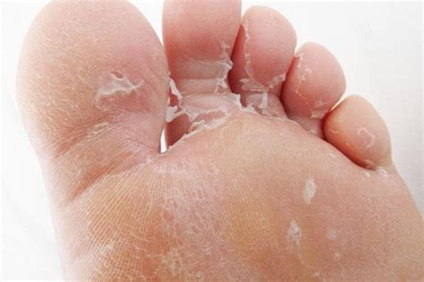 athletes foot is most common cause of peeling