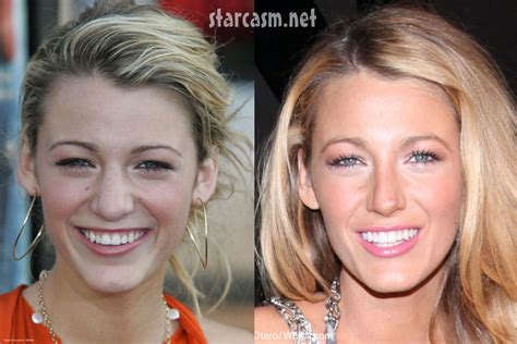 Blake Livelys Nose Job Before And After Plastic Surgery Photos
