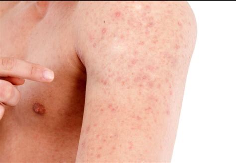 Dr Dave Stukus On Twitter Keratosis Pilarischronic Harmless Skin