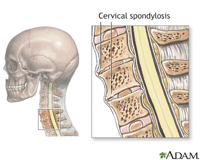 Cervical Spondylosis Allina Health