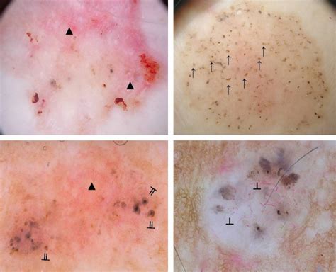 Dermatoscopy Of Basal Cell Carcinoma Morphologic Variability Of Global