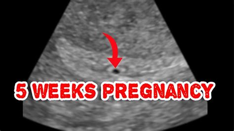 Early Pregnancy Sac On Ultrasound Intradecidual Sac Sign Youtube