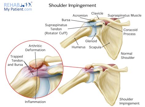 Westcoast Sci What Is A Shoulder Impingement