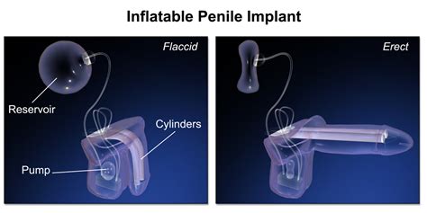 Penile Implant