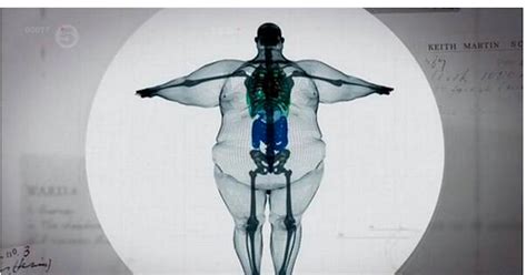 Shocking Mri Scan Picture Of 64 Stone Man Will Put You Off