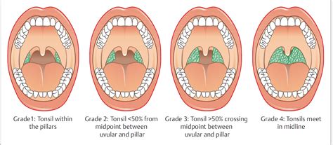 Difference Between Tonsil And Adenoids