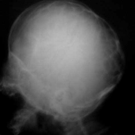 Occipital Lump A Unilateral Mass In The Left Occipital Area With