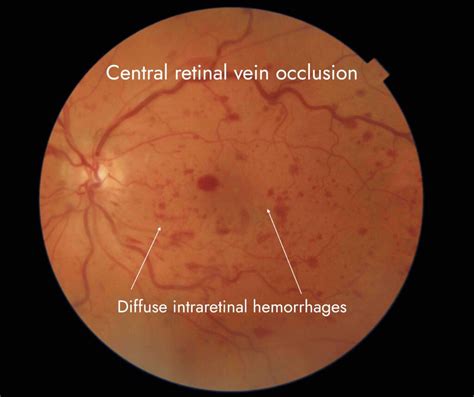Central Retinal Vein Occlusion Crvo Treatment Crvo Causes
