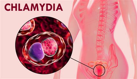 15 Home Remedies That Are Effective To Control Chlamydia