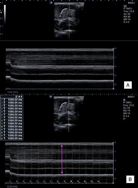 Raw M Mode Ultrasound Imaging A And Thickness Measurement B