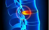 Therapy For Degenerative Disc Disease Pictures