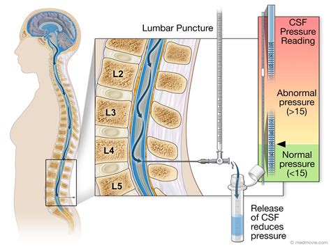 Lumbar Puncture Anatomy Layers
