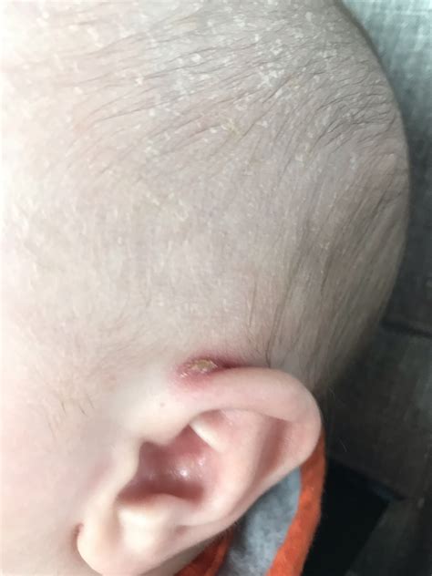 Cracked Dry Skin Behind Ear August 2018 Babies Forums What To Expect