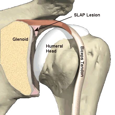 What Exactly Is A Slap Lesion Top Things You Need To