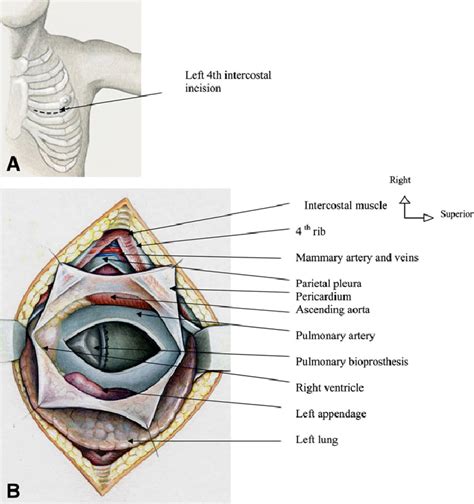 Surgical Scheme Showing Left Anterolateral Incision A With Exposure