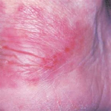 Erythema Migrans Erythematous Plaque With Centrifugal Growth