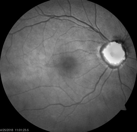 Fundus Autofluorescence Of Optic Disc Drusen Retina Image Bank