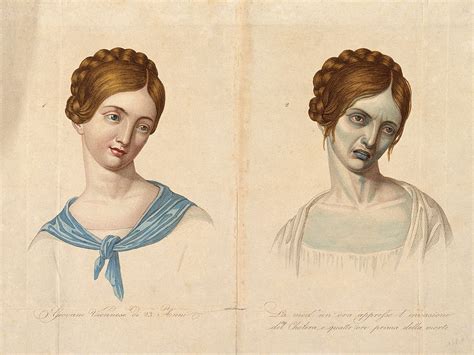 Awesomely Gross Medical Illustrations From The 19th Century Medical