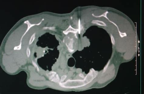 Right Paravertebral Mass And Left Apical Mass Lesions In Prone Patient