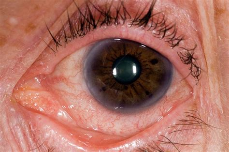 Viral Conjunctivitis Of The Eye Photograph By Dr P Marazziscience