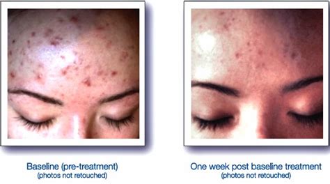 Sp Acne1 Skin By Design Dermatology And Laser Center Pa