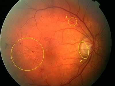 See classification by retinal findings for precise descriptions. Diabetic Retinopathy - Classification of Diabetic ...
