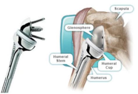 Shoulder Resurfacing Sudhir Rao Knee Hip And Shoulder Surgeon