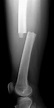 Femur Shaft Fractures (Broken Thighbone) - OrthoInfo - AAOS