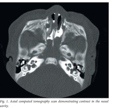 Figure 1 From Salivary Gland Anlage Tumour A Rare Cause Of Congenital