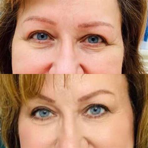 The Blackledge Botox Brow Lift Blackledge Face
